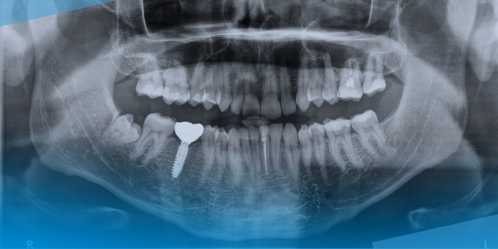 Santa Margarita Dental Group Cost of Cosmetic Dental Implants